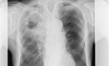 Lunge mit Tuberkulose © Gesundheitsamt Düsseldorf