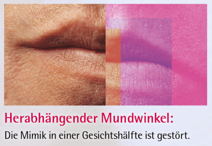 Grafik herabhängender Mundwinkel ©Böhringer Ingelheim
